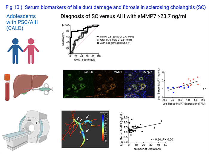 Identifying Biomarkers Directly Related to Progression of Biliary Duct Injury and Fibrosis in Children